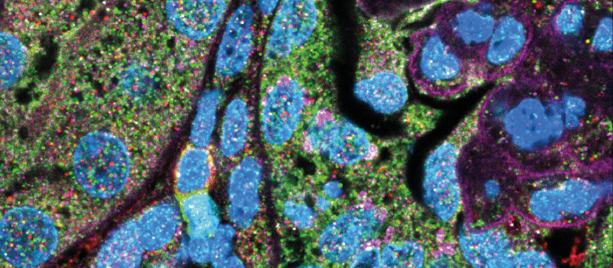 Immunofluorescence staining of MAIT cells (green) next to mononuclear phagocytes (red) in kidney sections of mice with experimental glomerulonephritis. Cell nuclei in blue. Image: Nature Communications, DOI: 10.1038/s41467-023-43269-0